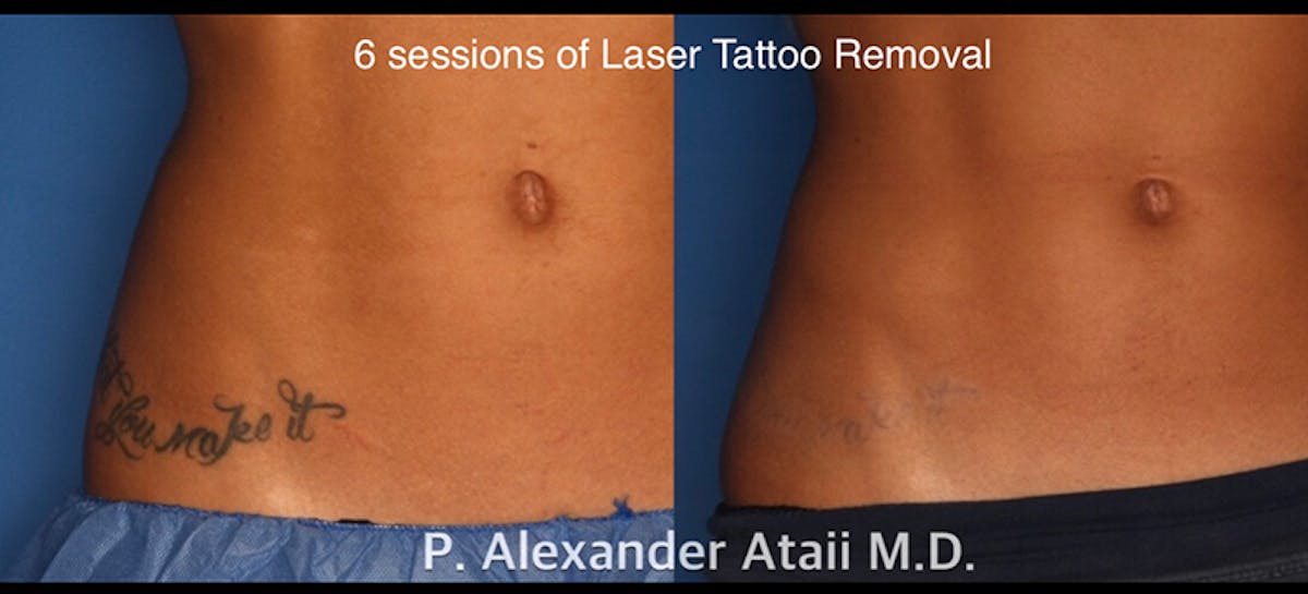 Laser Tattoo Removal Before & After Gallery - Patient 24560582 - Image 1