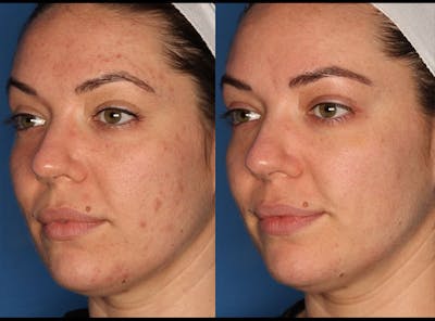 Photodynamic Therapy with Blu-U Before & After Gallery - Patient 24560585 - Image 1