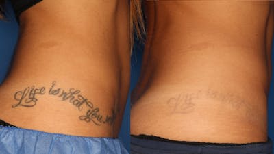 Laser Tattoo Removal Before & After Gallery - Patient 24560582 - Image 2