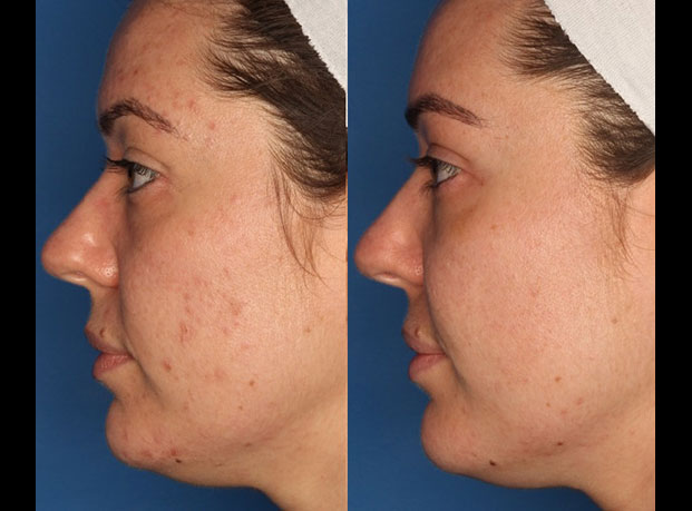 Photodynamic Therapy with Blu-U Before & After Gallery - Patient 24560585 - Image 2