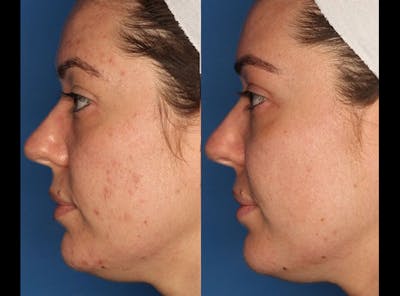 Photodynamic Therapy with Blu-U Gallery Before & After Gallery - Patient 24560585 - Image 2