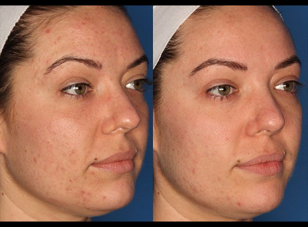 Photodynamic Therapy with Blu-U Before & After Gallery - Patient 24560585 - Image 3