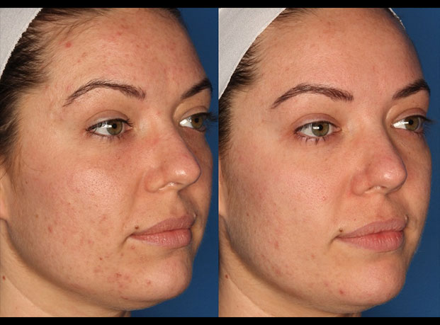 Photodynamic Therapy with Blu-U Gallery Before & After Gallery - Patient 24560585 - Image 3