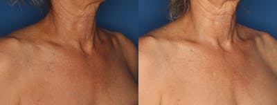 IPL Photorejuvenation Gallery Before & After Gallery - Patient 24560612 - Image 1