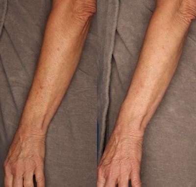 IPL Photorejuvenation Gallery Before & After Gallery - Patient 24560612 - Image 2