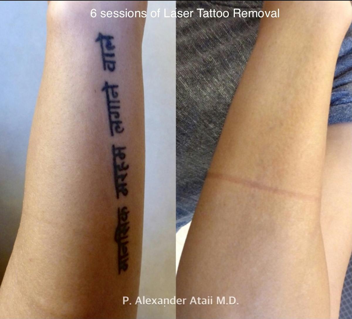 Laser Tattoo Removal Before & After Gallery - Patient 24560611 - Image 1