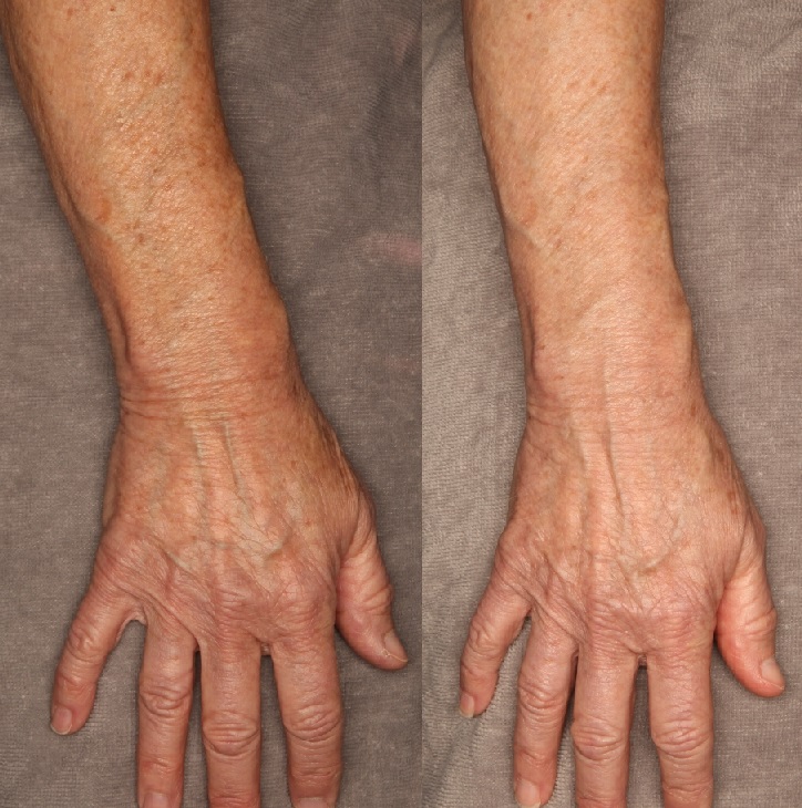 IPL Photorejuvenation Gallery Before & After Gallery - Patient 24560612 - Image 3