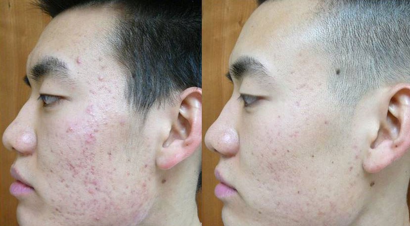 Photodynamic Therapy with Blu-U Before & After Gallery - Patient 24560613 - Image 1