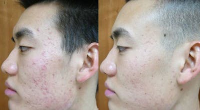 Photodynamic Therapy with Blu-U Before & After Gallery - Patient 24560613 - Image 1