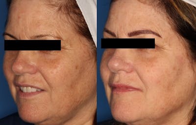 IPL Photorejuvenation Gallery Before & After Gallery - Patient 24560624 - Image 1