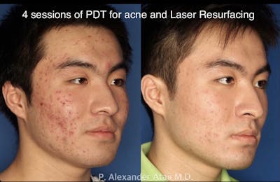 Photodynamic Therapy with Blu-U Before & After Gallery - Patient 24560629 - Image 1