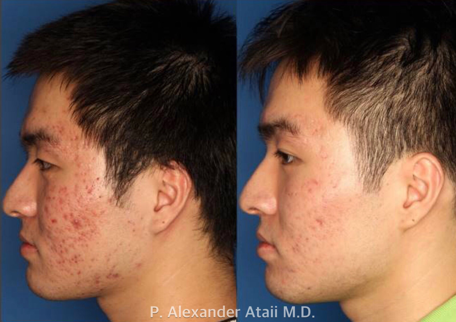 Photodynamic Therapy with Blu-U Gallery Before & After Gallery - Patient 24560629 - Image 2