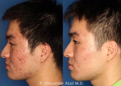 Photodynamic Therapy with Blu-U Gallery Before & After Gallery - Patient 24560629 - Image 2