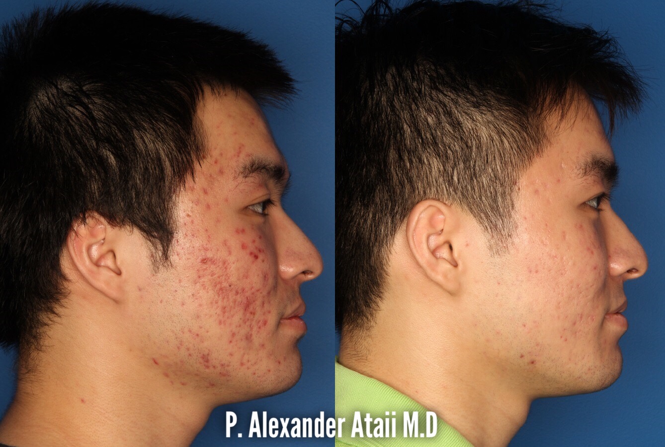 Photodynamic Therapy with Blu-U Before & After Gallery - Patient 24560629 - Image 3