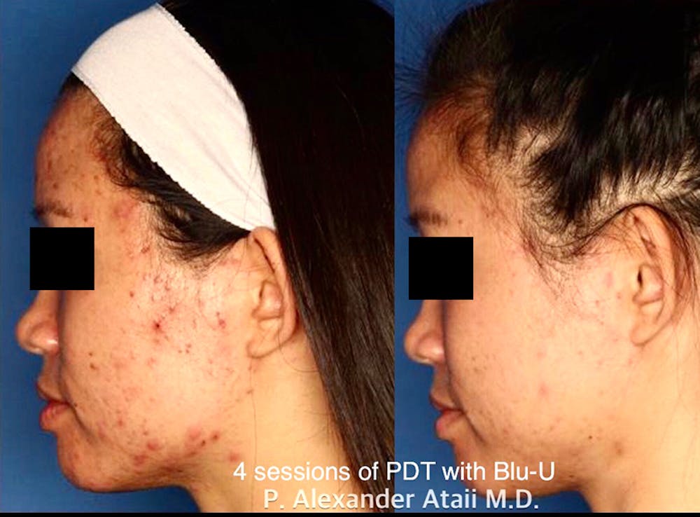 Photodynamic Therapy with Blu-U Before & After Gallery - Patient 24560632 - Image 1