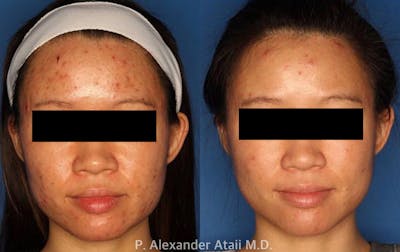Photodynamic Therapy with Blu-U Gallery Before & After Gallery - Patient 24560632 - Image 2
