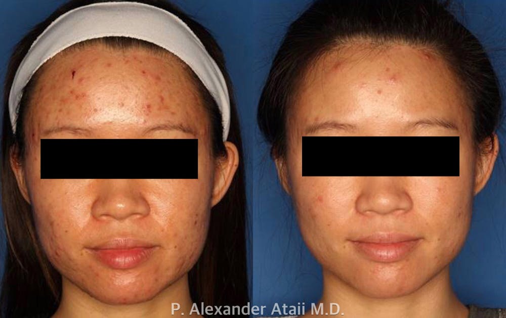 Photodynamic Therapy with Blu-U Before & After Gallery - Patient 24560632 - Image 2