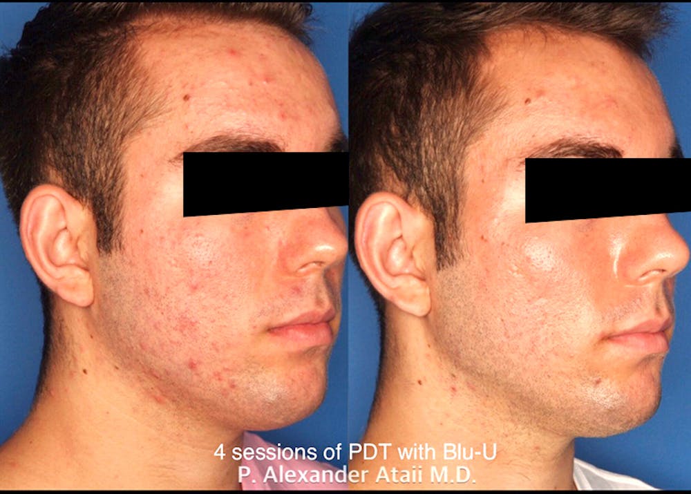 Photodynamic Therapy with Blu-U Before & After Gallery - Patient 24560640 - Image 1