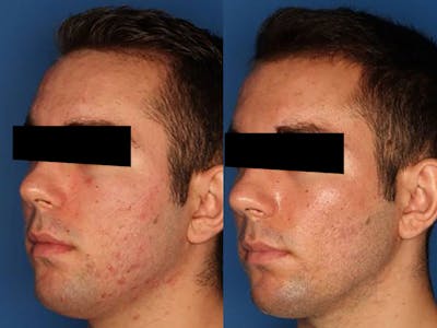 Photodynamic Therapy with Blu-U Gallery Before & After Gallery - Patient 24560640 - Image 2