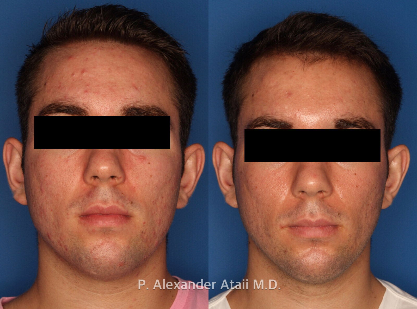 Photodynamic Therapy with Blu-U Before & After Gallery - Patient 24560640 - Image 3