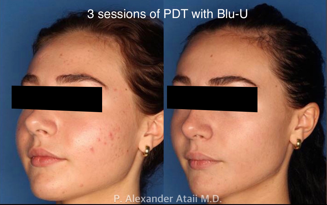 Photodynamic Therapy with Blu-U Before & After Gallery - Patient 24560644 - Image 1