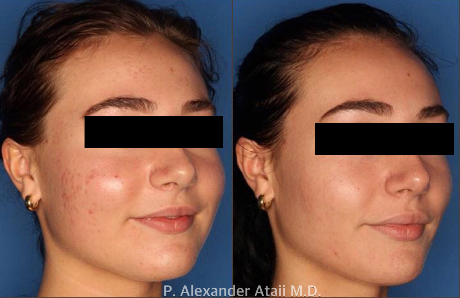 Photodynamic Therapy with Blu-U Before & After Gallery - Patient 24560644 - Image 2