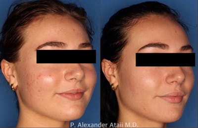 Photodynamic Therapy with Blu-U Gallery Before & After Gallery - Patient 24560644 - Image 2