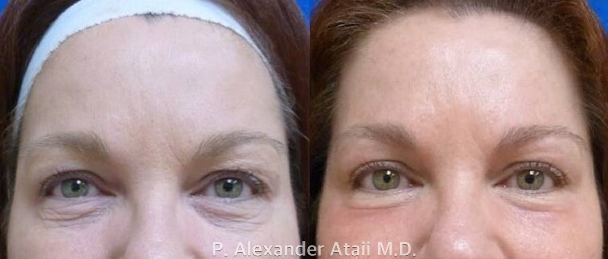 TotalFX Before & After Gallery - Patient 24560648 - Image 1