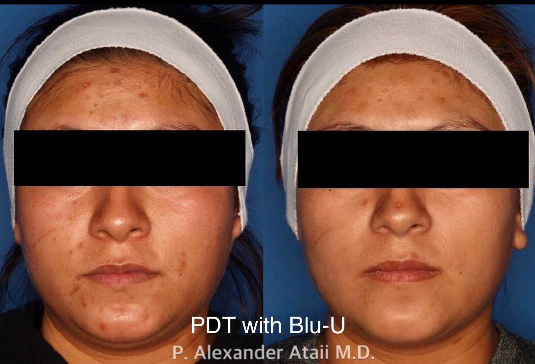 Photodynamic Therapy with Blu-U Before & After Gallery - Patient 24560649 - Image 1