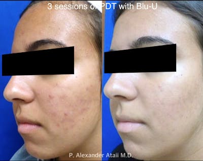 Photodynamic Therapy with Blu-U Before & After Gallery - Patient 24560663 - Image 1