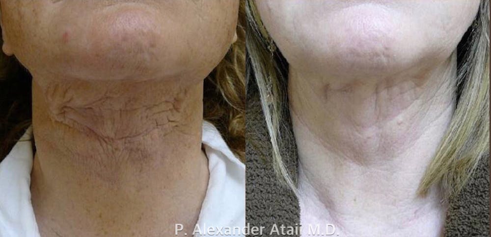 TotalFX Before & After Gallery - Patient 24560661 - Image 2