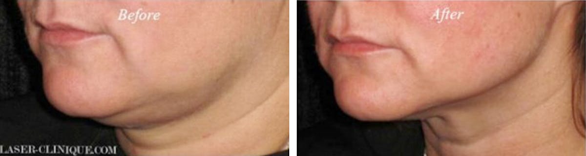 Ultherapy Before & After Gallery - Patient 24560658 - Image 1