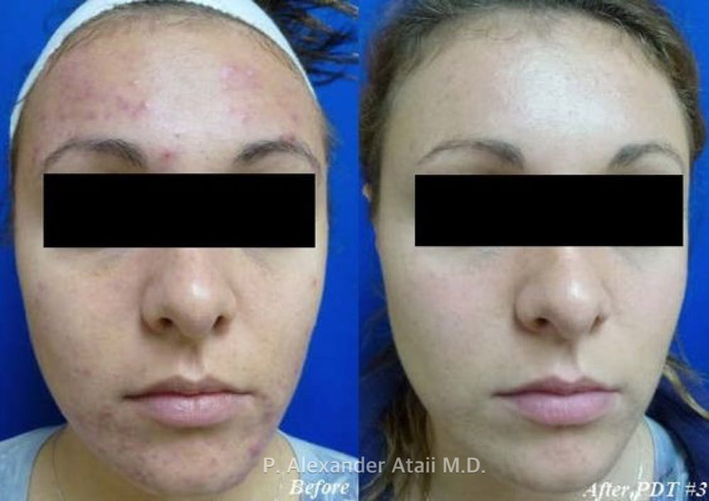Photodynamic Therapy with Blu-U Before & After Gallery - Patient 24560663 - Image 2