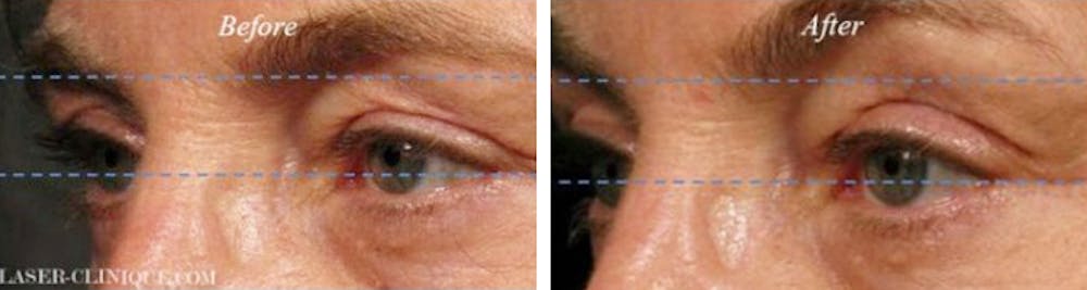 Results from Ultherapy in San Diego