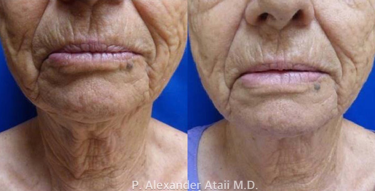 Ultherapy Before & After Gallery - Patient 24560671 - Image 1