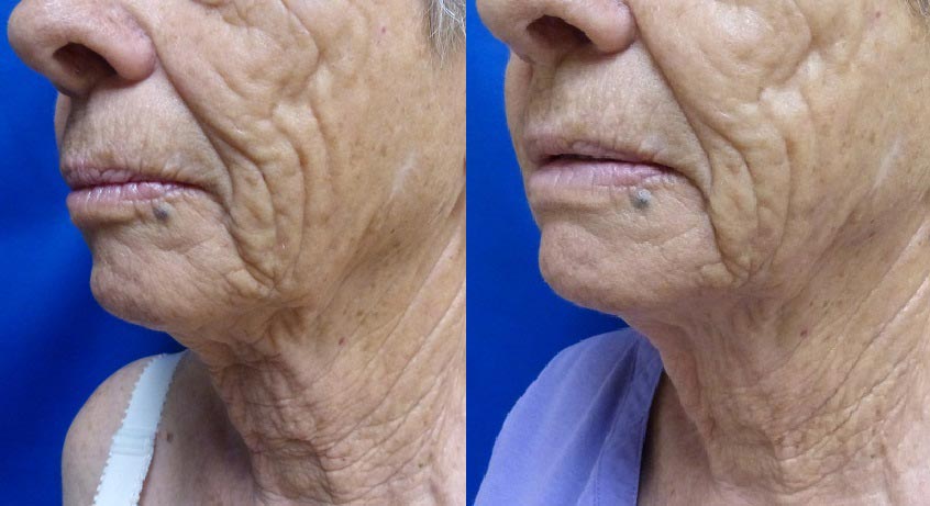 Ultherapy Gallery Before & After Gallery - Patient 24560671 - Image 2