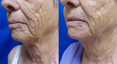 Ultherapy Gallery Before & After Gallery - Patient 24560671 - Image 2