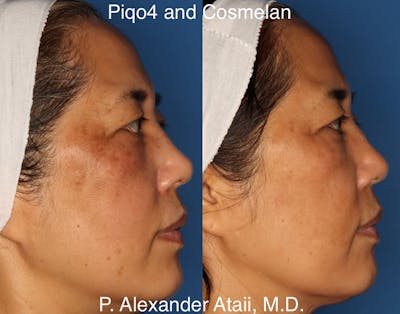 PiQo4™ Laser Gallery Before & After Gallery - Patient 24560672 - Image 2