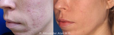 TotalFX Before & After Gallery - Patient 24560673 - Image 1