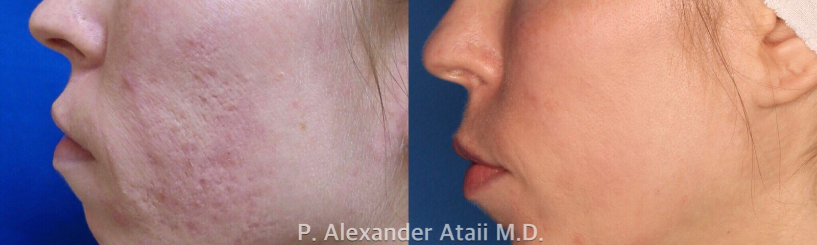 TotalFX Before & After Gallery - Patient 24560673 - Image 2