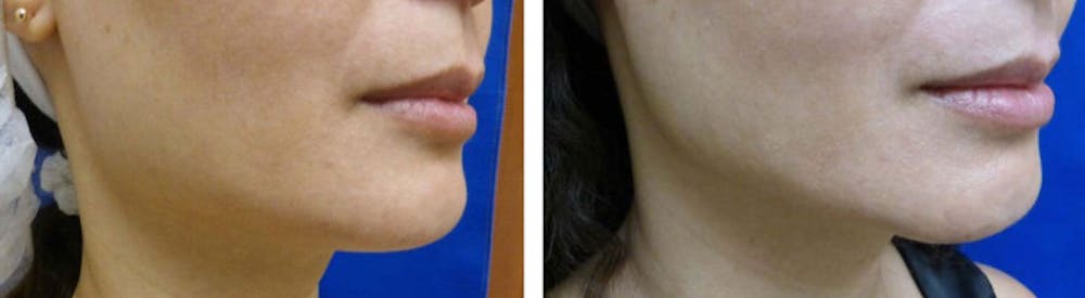 Before and After Ultherapy in La Jolla