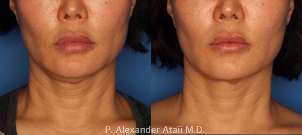 Ultherapy Gallery Before & After Gallery - Patient 24560678 - Image 1