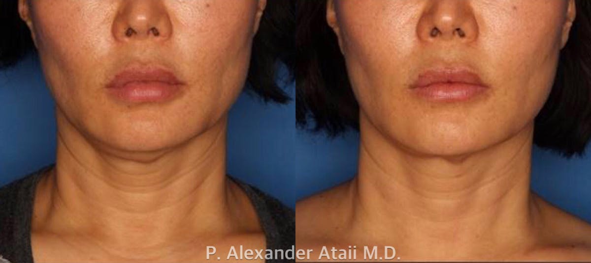 Ultherapy Before & After Gallery - Patient 24560678 - Image 1