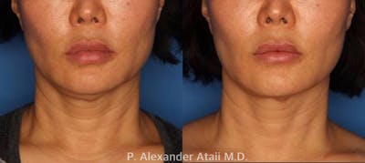 Ultherapy Gallery Before & After Gallery - Patient 24560678 - Image 1