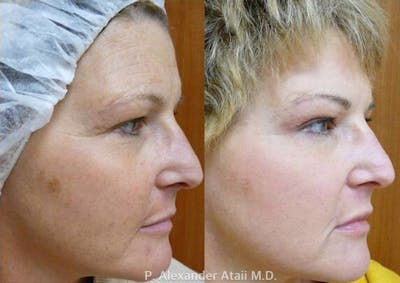 TotalFX Before & After Gallery - Patient 24560679 - Image 2