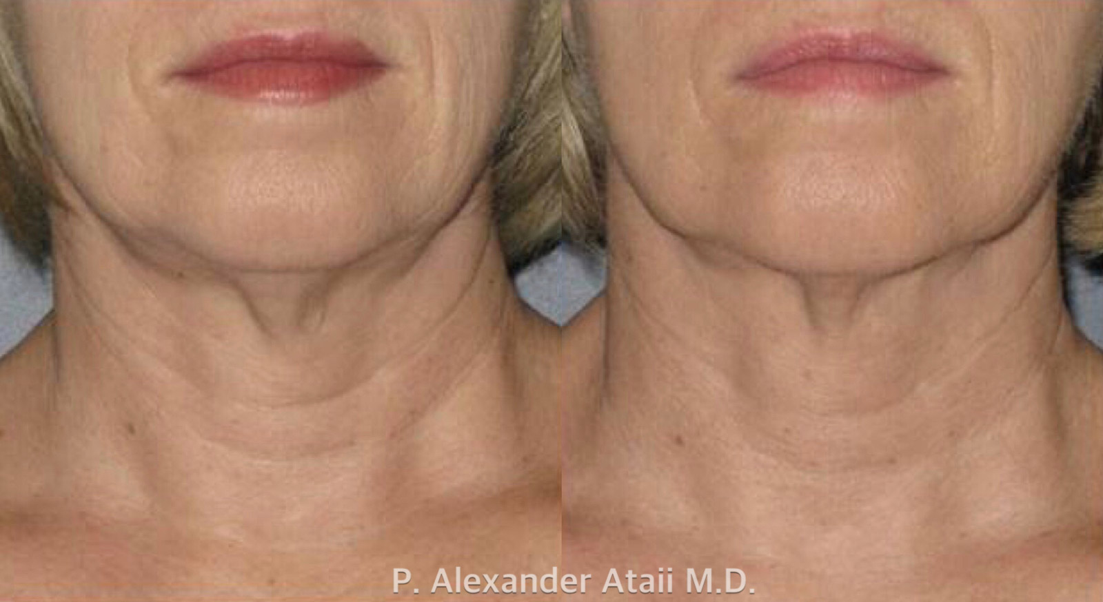 Ultherapy Before & After Gallery - Patient 24560682 - Image 1
