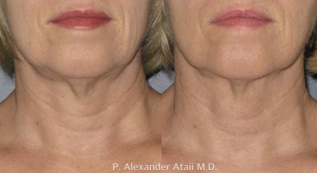 Ultherapy Gallery Before & After Gallery - Patient 24560682 - Image 1