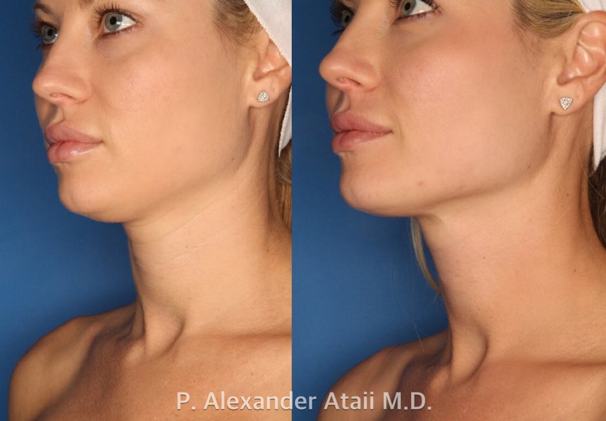 Ultherapy Gallery Before & After Gallery - Patient 24560689 - Image 1