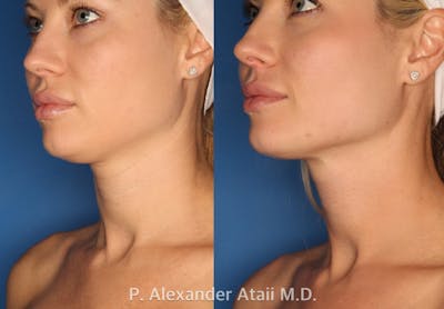 Ultherapy Gallery Before & After Gallery - Patient 24560689 - Image 1
