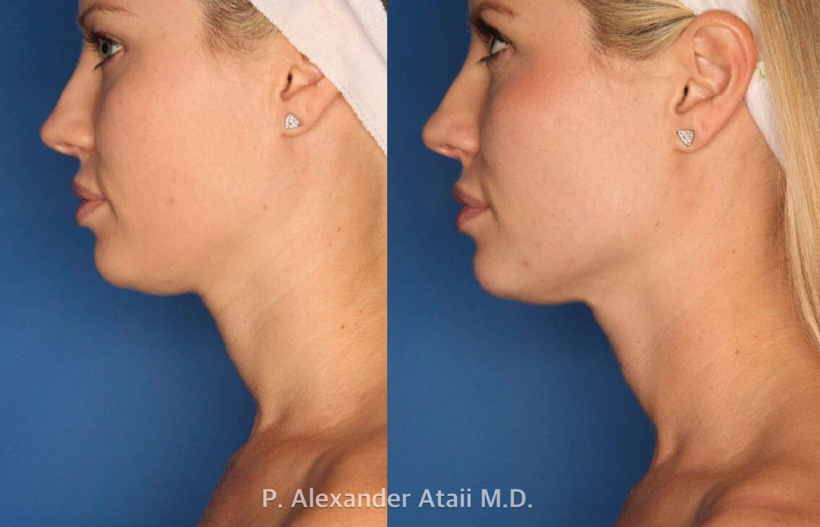 Ultherapy Gallery Before & After Gallery - Patient 24560689 - Image 2